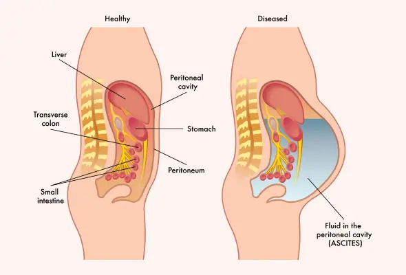 استسقاء البطن (Ascites): الأسباب، الأعراض، وطرق سحب السوائل والسيطرة عليها